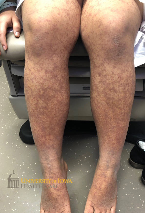 Diffuse violaceous and purupuric plaques , some with arcuate borders, and paules on the lower legs. (click images for higher resolution).